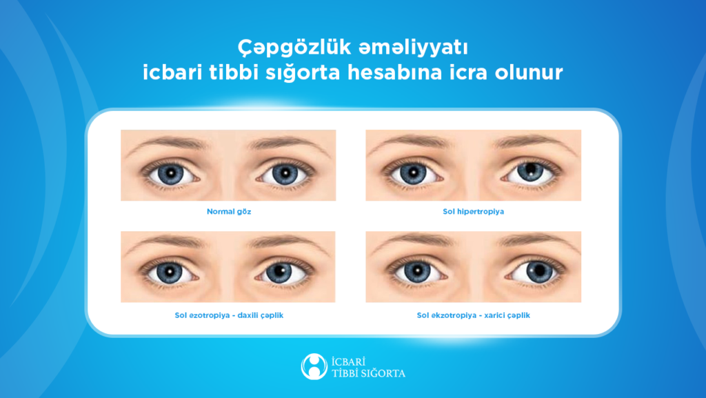 Çəpgözlük əməliyyatı icbari tibbi sığorta hesabına qarşılanır Sayt.png